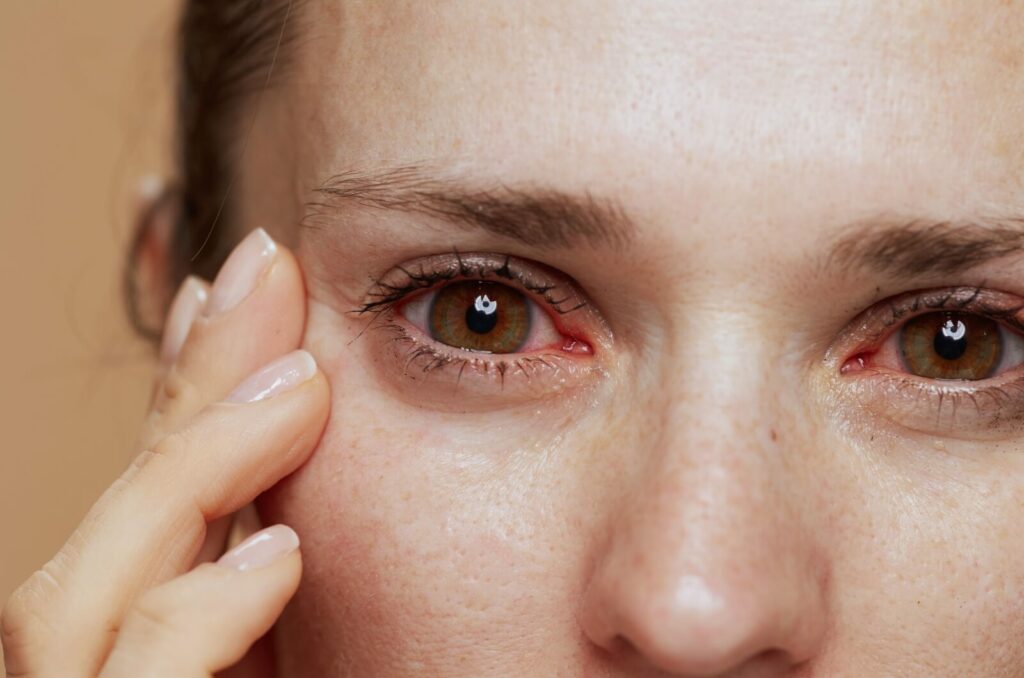 A person touches the side of their right eye, both eyes are red and watery.