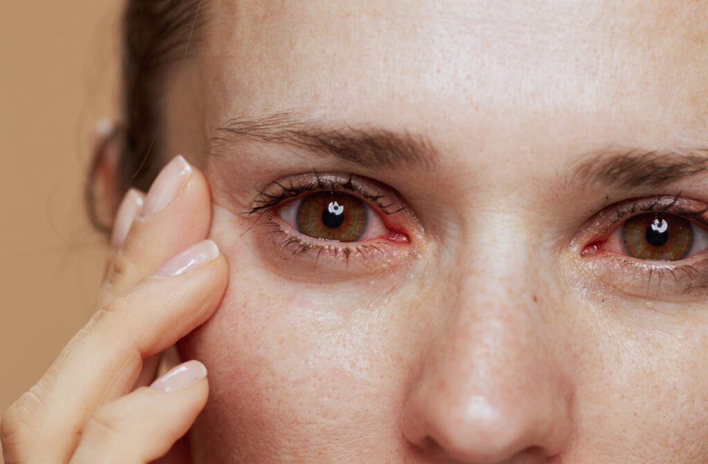 A close-up of a person's dry, red, irritated eyes.