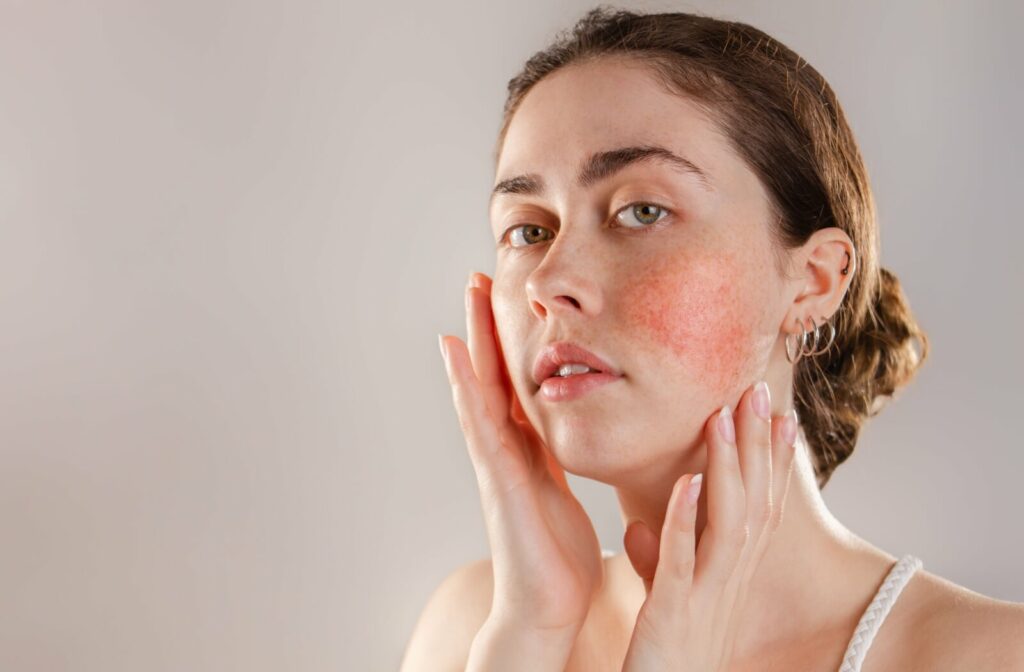 Woman with rosacea touching her face, showing visible redness and inflammation on her cheeks.
