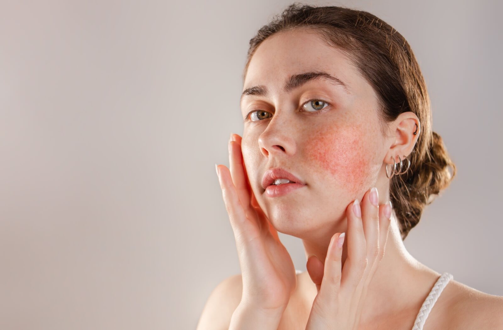 Woman with rosacea touching her face, showing visible redness and inflammation on her cheeks.