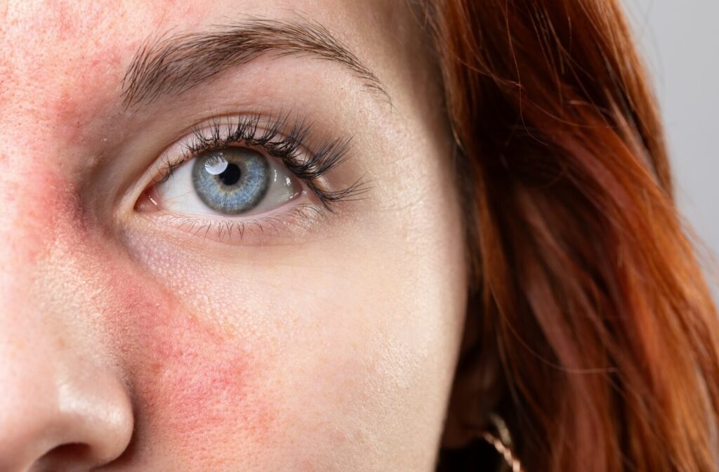 Close-up of a woman’s eye with visible facial redness and irritation from rosacea.