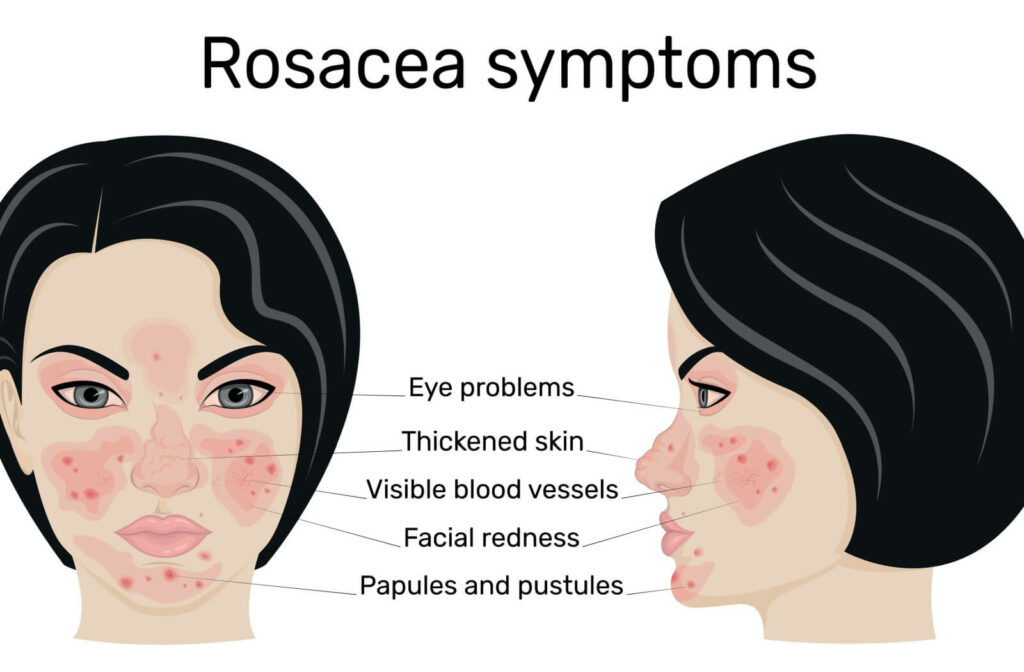 A graphic that highlights rosacea's common symptoms.